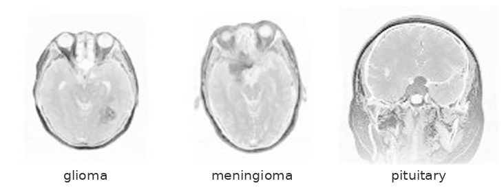Example T1-weighted contrast-enhanced MRI slices for glioma, meningioma and pituitary tumours