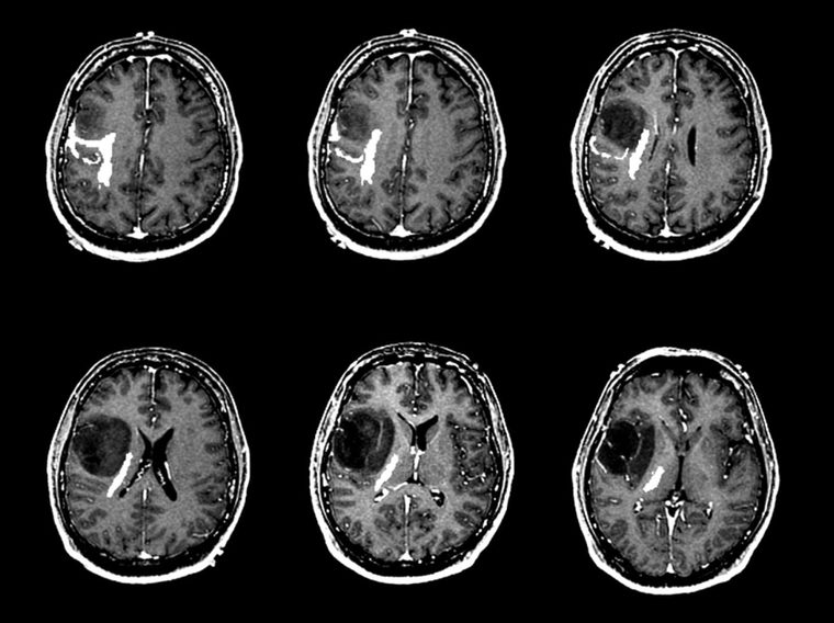 Brain Tumor Classification Using Convolutional Neural Network