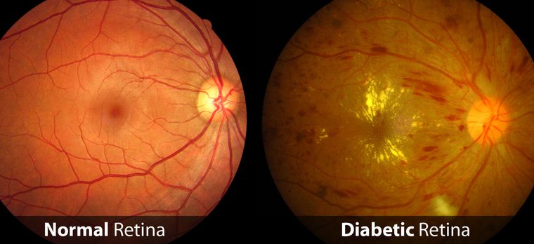 Automatic Diabetic Retinopathy Classification with EfficientNet
